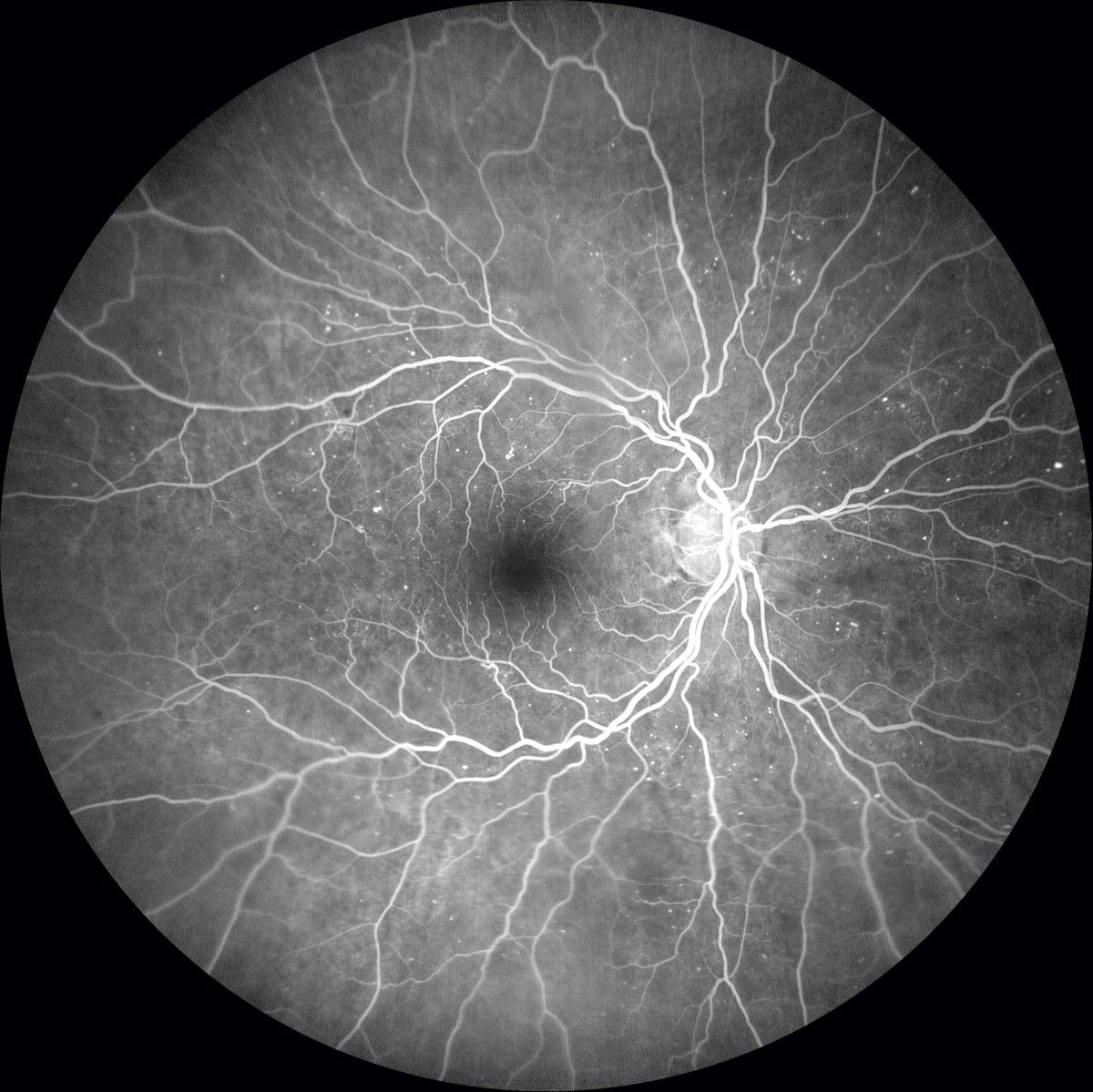 fluoresceinangiogram Best Practice Eyecare caloundra Ophthalmologist Sunshine Coast